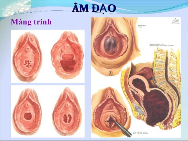 Có nên vá màng trinh không? 